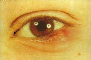 眼皮发炎图片,眼皮发炎症状解析与应对策略