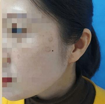 面部老年斑图片